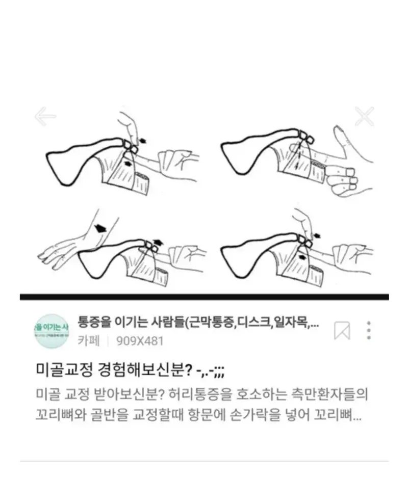 항문에 직접손을 넣어 척추교정하는 미골교정