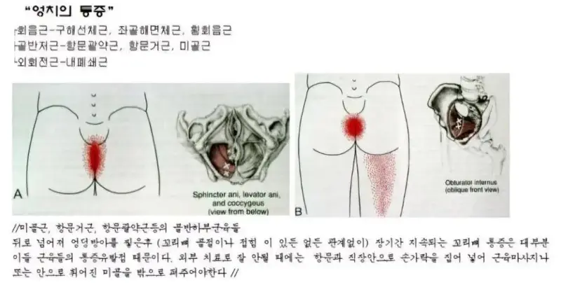 항문에 직접손을 넣어 척추교정하는 미골교정