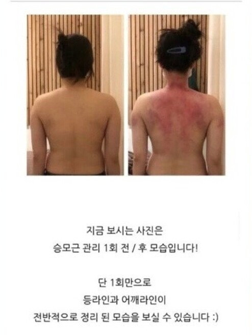 어느 여성의 승모근 교정 후기