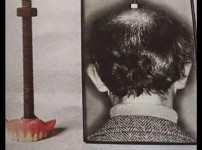 1930년대식 임플란트