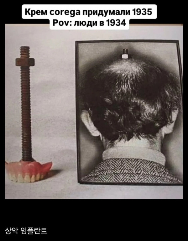 1930년대식 임플란트