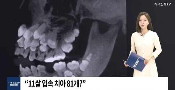 브라질 치아가 81개인 11살