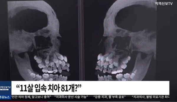 브라질 치아가 81개인 11살
