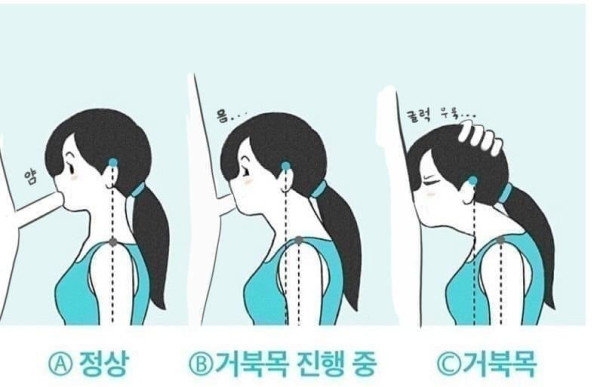 거북목 진단법 ㄷㄷㄷㄷㄷㄷ