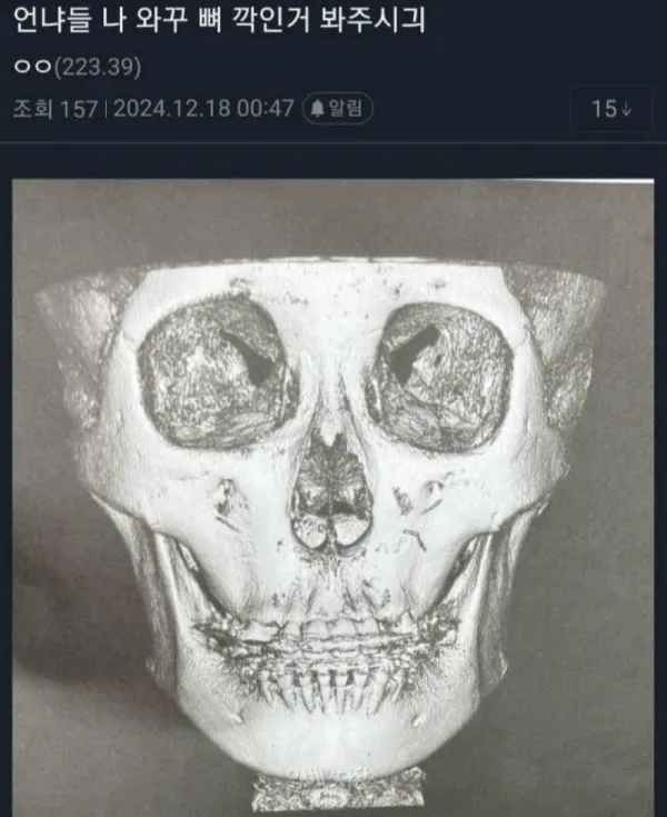 윤곽수술하면 뼈 이렇게 깎는구나...