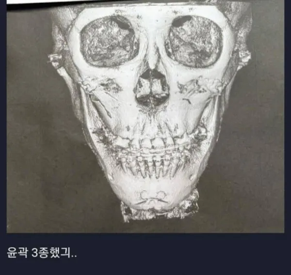 윤곽수술하면 뼈 이렇게 깎는구나...
