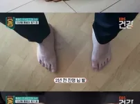 30대 통풍 환자의 발 상태 ㄷㄷㄷㄷㄷㄷ