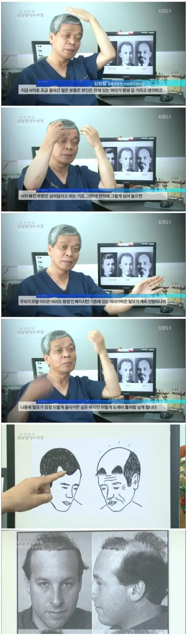M자 탈모의 위험성