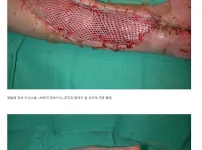 극극혐 주의) 독사에게 손을 물린 사람의 재활기