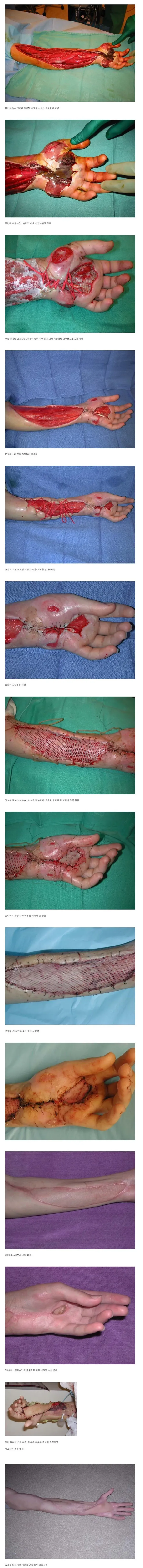 극극혐 주의) 독사에게 손을 물린 사람의 재활기