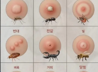 벌레별 물린 자국 구별하는 법