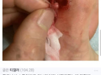 티눈..